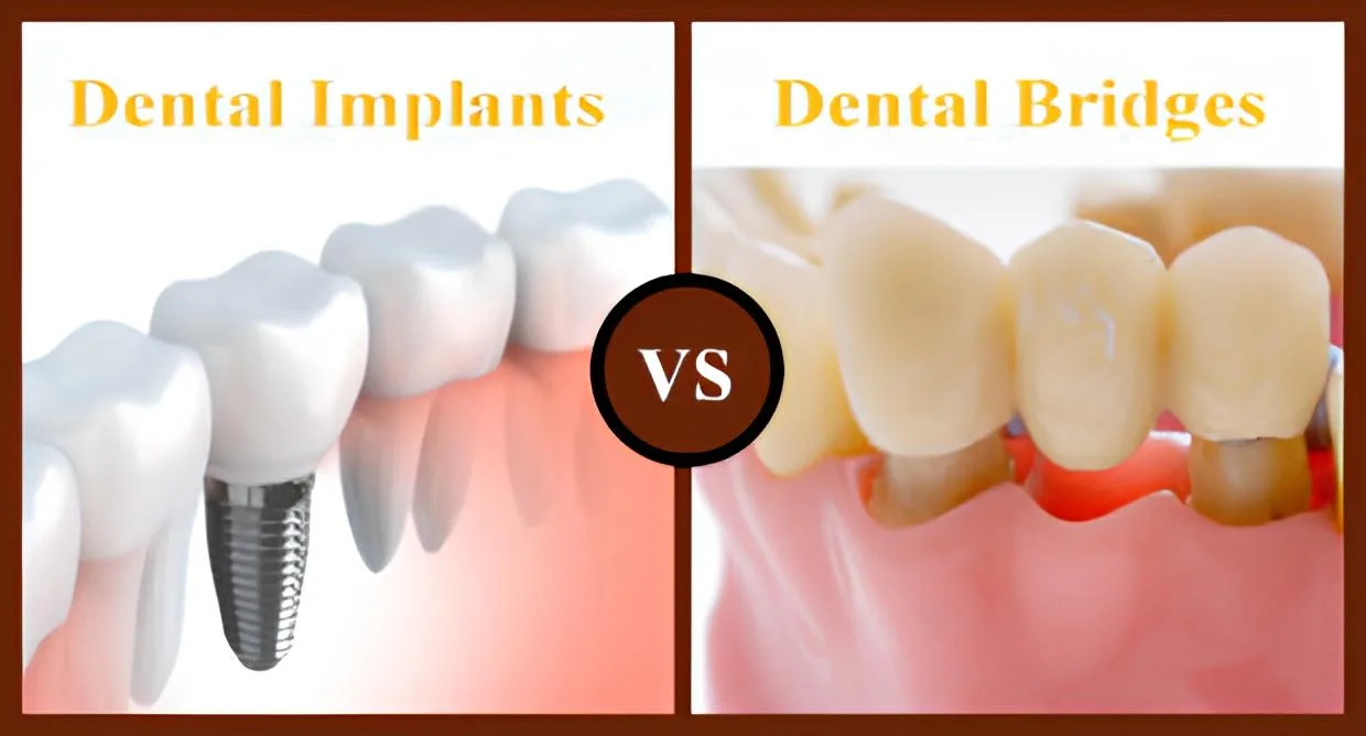 dental bridges vs dental implants